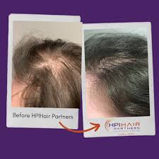 But first, screening for low serum ferritin levels is very important, because supplementing with iron when iron levels are normal or high can result in iron overload and toxicity 7. Nashville Hormone Hair Loss Treatment Androgenetic Alopecia Hpi
