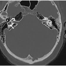 Pdf Dissociated Responses To Caloric And Head Impulse Stimulation In A Case Of Isolated Vestibule Lateral Semicircular Canal Dysplasia