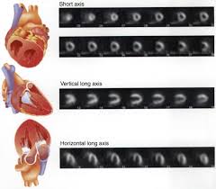 Image result for Nuclear Ventriculogram