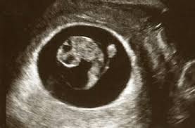 Dating and viability scan from 6 weeks. Early Pregnancy Scans Dubai Fetal Medicine Specialists Dubai