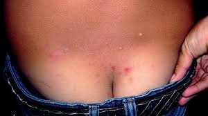 Image result for scabies bite