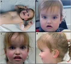 Wolf–Hirschhorn syndrome facial dysmorphic features in a patient with a  terminal 4p16.3 deletion telomeric to the WHSCR and WHSCR 2 regions