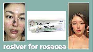 Ivermectin is efficacious in decreasing inflammatory lesion counts and erythema. Rosiver Ivermectin Cream For Rosacea Review Youtube