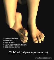 Club foot may affect one or both feet. Clubfoot