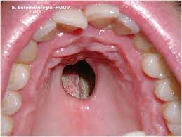 Would a clinical trial be appropriate for me? The Horrific Effects Of Cocaine Eroding The Roof Of Your Mouth Leaving Gaping Holes