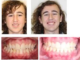 Some patients, before their braces are removed, will ask their friends about getting their braces off and their friends may exaggerate their orthodontic experiences. Orthodontist Reviews In Vallejo Benicia Ca Chun Orthodontics