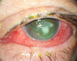 From wikipedia, the free encyclopedia. Fungal Keratitis Eyewiki