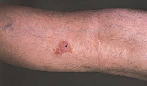 These cells make up the epithelium, which is the tissue that lines the surfaces inside and outside your body. Squamous Cell Carcinoma Dermatologic Disorders Msd Manual Professional Edition