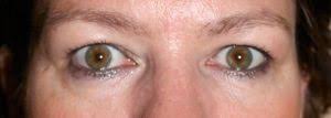 Como Quitar Las Ojeras Oscuras Y Hundidas