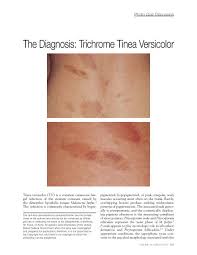 Apr 25, 2018 · pityriasis rubra pilaris is a rare skin disorder that causes skin inflammation and shedding. The Diagnosis Trichrome Tinea Versicolor