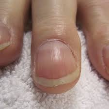 It's not connected with the colour pink. Nail Clubbing Definition Causes And Diagnosis