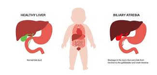 Image result for Intestinal Atresia