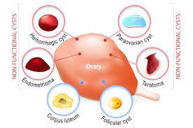 Girls with pcos are not ovulating or releasing an egg each month, so many have irregular or missed periods. Are Ovarian Cysts The Same Thing As Pcos Nabta Health