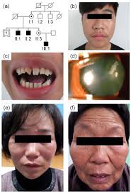 Pedigree structure and patient phenotypes of the family (a) Pedigree of... 