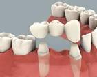 Cost For 3 Tooth Bridge In Bangalore - I Want To Replace A 3 ...