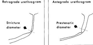 Image result for Retrograde Urethrogram