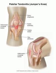 Knieblessures Oorzaak Preventie Behandeling En Revalidatie Knee Arthritis Patellar Tendonitis Knee