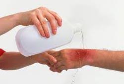 حروق الماء الساخن وبخاره