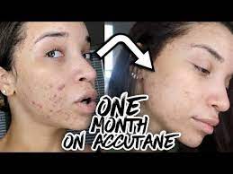 Duration of treatment with accutane normally the duration ranges from 4 to 6 months. First Month On Accutane It S Working Acne Update 4 Youtube