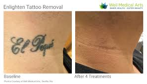 More Awesome Results With Our Cutera Enlighten Tattoo Removal Laser At Well Medical Arts Tattoo Removal Tattoos Medical Art