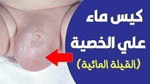 اسباب انتفاخ الخصية عند الاطفال كيس ماء علي الخصية القيلة المائية youtube
