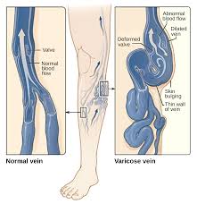 Compression Stockings Wikipedia