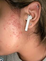 Sideburns don't get their fair share of grooming coverage, a generally neglected component of the super hair removal (shr) is based on improved intense pulsed light technology, with the highest. Hair Removal Help I Used Was Face Strips On My Sideburns 3 4 Days Ago And Now I Have A Thousand Inflamed Red Bumps On Both Sides Of My Face It S Painful And