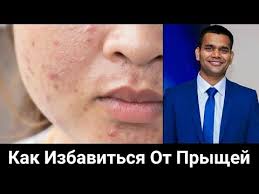 как убрать рубцы от прыщей на лице народные средства Doktor Vivek Pro Akne Pryshi Diety Prichiny I Effektivnoe Sredstvo Youtube Bystrye Trenirovki Dieta Doktor