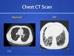 515 likes · 6 talking about this. Fibroza PulmonarÄ IdiopaticÄ Pot Trece Èi 2 Ani PanÄ La Stabilirea Diagnosticului Corect Ce InvestigaÈii Specifice Sunt Necesare Raportul De GardÄ