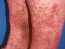 Hives, also known as nettle rash, urticaria, welts or weals, are usually composed of reddish itchy weals or swellings in the skin. Rashes Affecting The Lower Legs Dermnet Nz