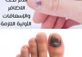 علاج احتباس الدم تحت الاظافر والإسعافات الأولية اللازمة صحتي هنا