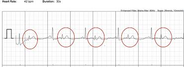 Look at this strip here, we have a p wave followed by a qrs expect here where you can see a wide and abnormal looking qrs. Alivecor Kardia Has A Premature Beat Problem How Pvcs And Pacs Confuse The Mobile Ecg Device The Skeptical Cardiologist