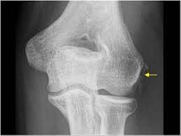 Lateral epicondylitis (tennis elbow) the advice of your health care provider because of any information you read in this booklet. Musculoskeletal Joints And Tendons 6 2 Elbow Case 6 2 1 Common Extensor Tendon Insertion And Lateral Epicondylitis Ultrasound Cases