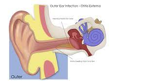 Clean the washcloth before proceeding with the other ear. Ear Infections Ear Institute Of Texas And Voice Swallowing Institute Of Texasear Institute Of Texas And Voice Swallowing Institute Of Texas
