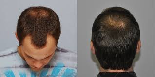 Customizing alpha hair texture youtube research on the. Hair Transplant Before And After Atlanta Alpharetta Ga Anderson Center For Hair