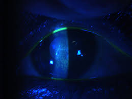 A controlled trial of oral acyclovir for iridocyclitis caused by herpes simplex virus. Bilateral Herpes Simplex Keratitis Lactation A Trigger For Recurrence Bmj Case Reports