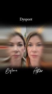 Soft and Stunning!🤩 , Not frozen, just soft., I’m def in my Soft Girl Era!  , 🩵🩷🩵🩷🩵🩷🩵🩷🩵🩷🩵🩷🩵, Thanks to our girl, Dysport., Without you,  these results would not be 😆, ⬇️ To Book⬇️, 💗Injector Artist ...