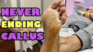 Learn more about your condition and possible remedies for relief. Another Leather Foot Youtube