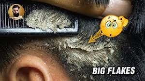 Pimple popper's fans speculate the mystery extraction is a worm, parasite, or simply alive. Best Of Flakes In Hair Free Watch Download Todaypk