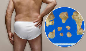 Get Rid Of Kidney Stones By Having Sex Express Co Uk
