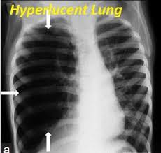 Hyperlucent Lung Radiography X Ray Respiratory Therapy