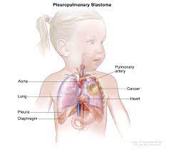In addition to disorders of pneumonia is an inflammatory condition of the lung affecting primarily the microscopic air sacs known as alveoli. Childhood Pleuropulmonary Blastoma Treatment Pdq Patient Version National Cancer Institute