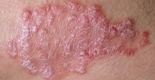 However, women get the disease more often than. Psoriasis Vs Lupus Similarities And Differences