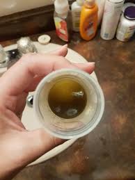 There is no specific treatment for a noisy movement of fluid. The Liquid On My Drain Is Dark Green 7 Days Tummy Tuck Post Op Is This Normal Photo