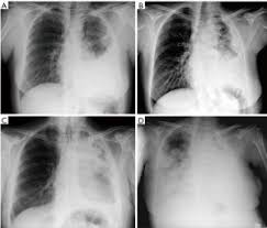 Clinical staging allows for selection of patients for treatment strategies, but has not been found to be prognostic and is plagued by high interobserver variability. Clinical Diagnosis Of Malignant Pleural Mesothelioma Bianco Journal Of Thoracic Disease