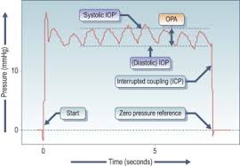 Applanation Tonometer An Overview Sciencedirect Topics