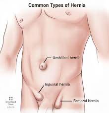 The groins are also on either side, around the crease where the leg joins the rest of the body. Hernia Types Treatments Symptoms Causes Prevention