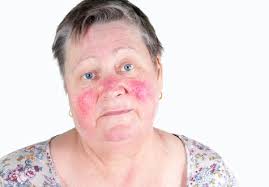 Why Is My Face So Red Two Common Skin Problems