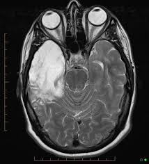 Encephalitis in the immunocompromised host. Temporal Lobe Atrophy Post Herpes Simplex Encephalitis Radiology Case Radiopaedia Org
