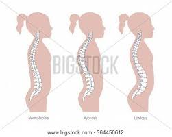 It's the taxonomic backbone that allows gbif to integrate. Girl Spinal Deformity Vector Photo Free Trial Bigstock
